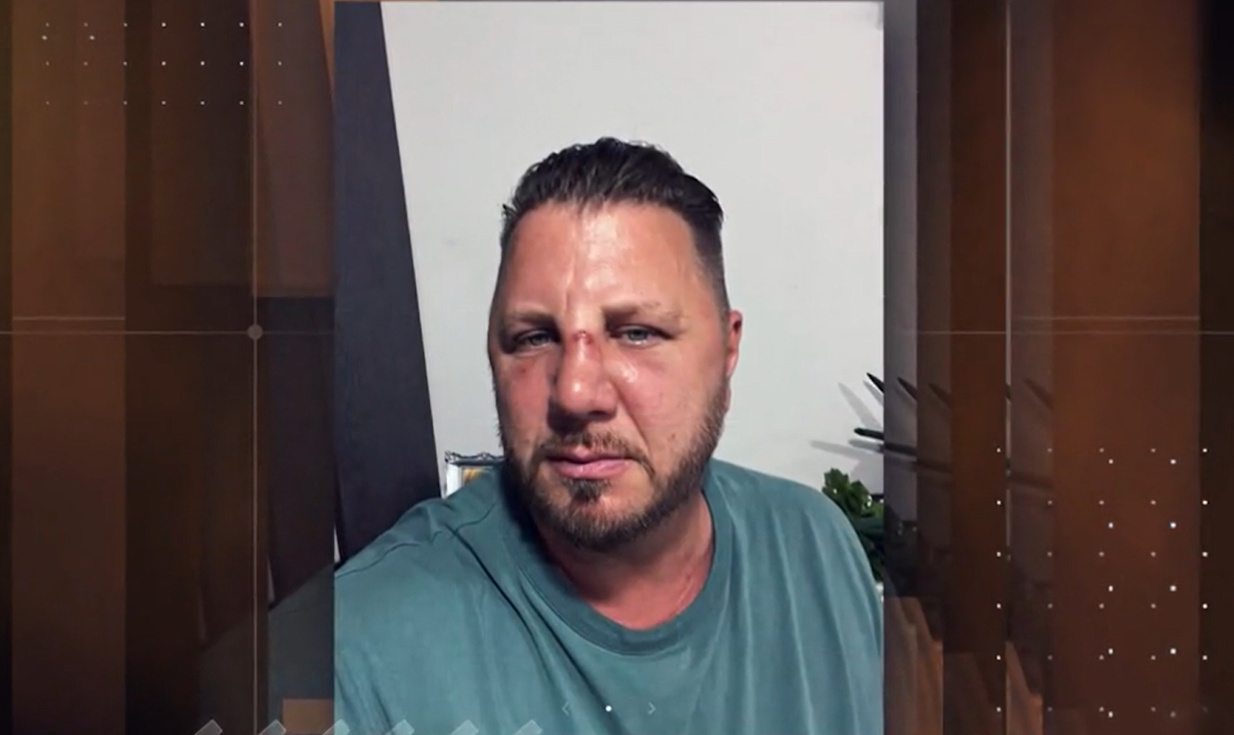 Zámbó Krisztián: Betörték az orrom! – videón az énekes orrtörése